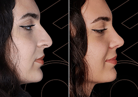 Rhinoplasty