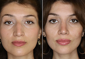 Rhinoplasty