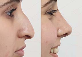 Rhinoplasty