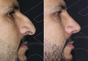 Rhinoplasty